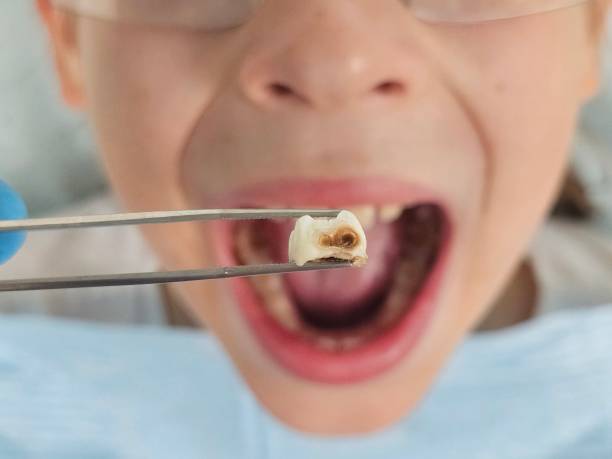 Best Broken or Cracked Tooth Emergency Dentist in El Macero, CA